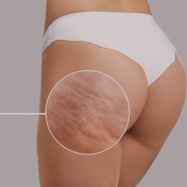 Anti-cellulitt massasje i Drammen med vakuumkopp for fastere og glattere hud hos Harmony SPA