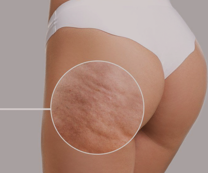 Anti-cellulitt massasje i Drammen med vakuumkopp for fastere og glattere hud hos Harmony SPA