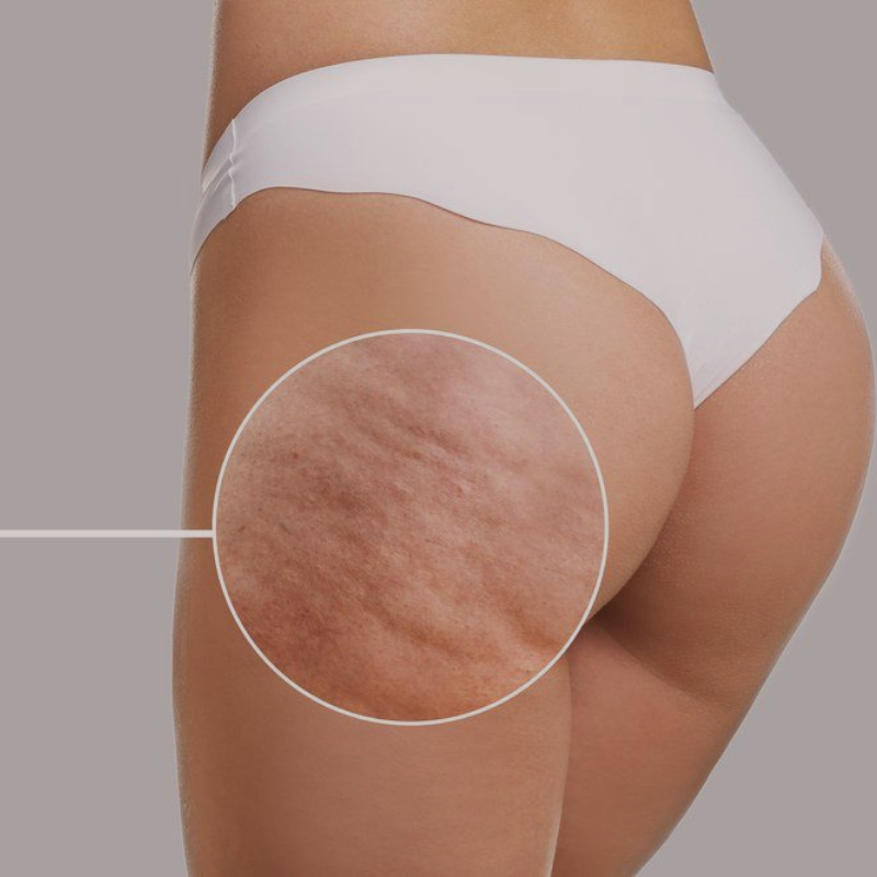 Anti-cellulitt massasje i Drammen med vakuumkopp for fastere og glattere hud hos Harmony SPA